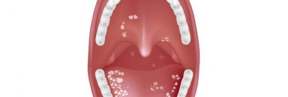 Молочница во рту