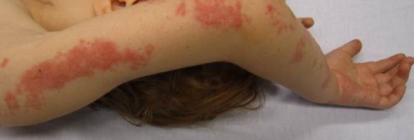 Как выглядит герпес у детей