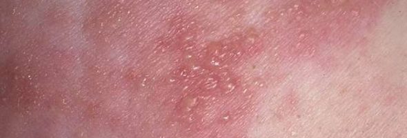 Как выглядит герпес на теле