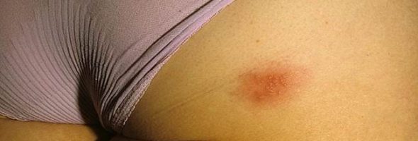 Герпес на интимном месте