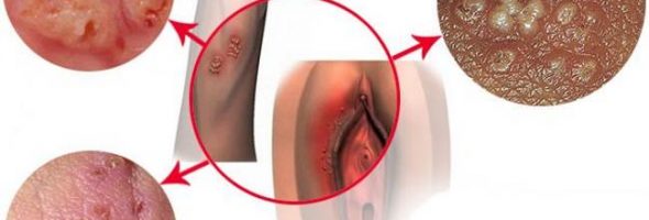 Половой герпес