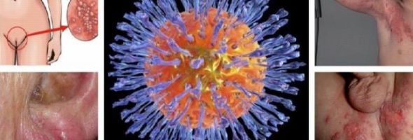 Виды герпеса на теле