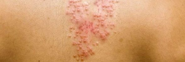 Как выглядит герпес на спине