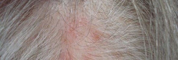 Герпес на голове в волосах