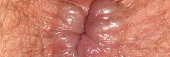 Как выглядит наружный геморрой