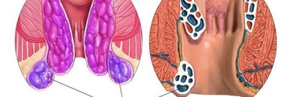 Внешний геморрой