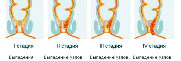 Внутренний геморрой