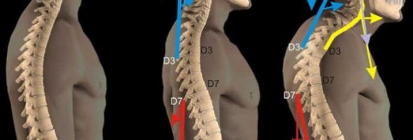 Как выглядит лордоз и кифоз