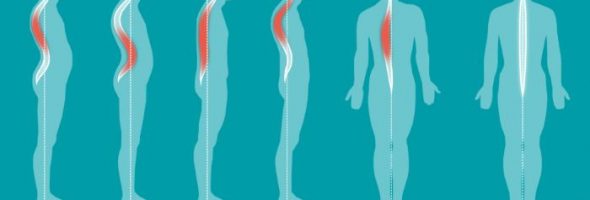 Сутулость и осанка