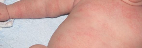 Как выглядит дисбактериоз