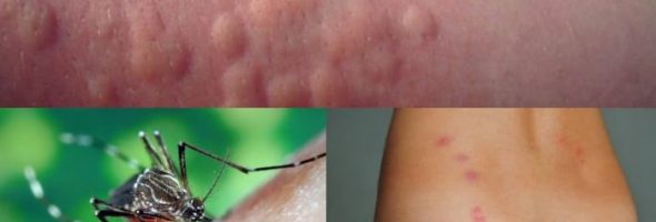 Аллергия на укусы насекомых