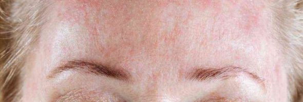 Аллергия на холод