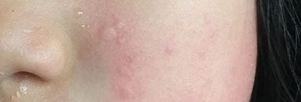 Холодовая аллергия