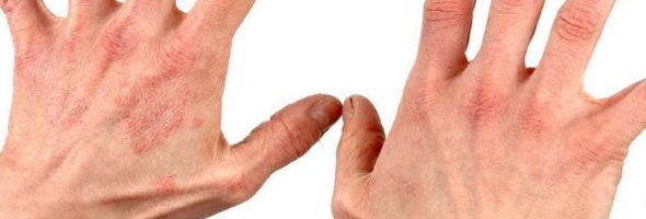 Как выглядит холодовая аллергия