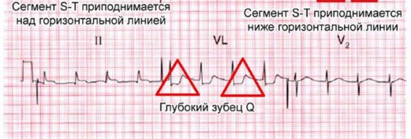 ЭКГ при инфаркте миокарда