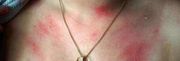 Аллергия на воду, кофе, чай