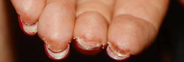 Аллергия на шеллак (гель-лак)