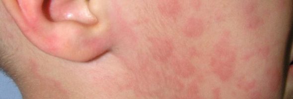 Аллергия на мед, конфеты и сахар