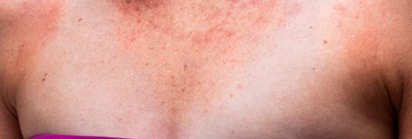 Аллергия на солнце