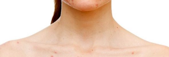 Пищевая аллергия