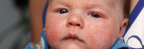 Пищевая аллергия у грудничка