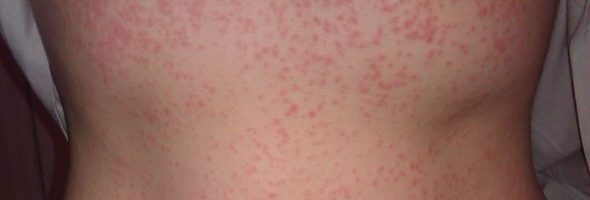 Аллергия на порошок