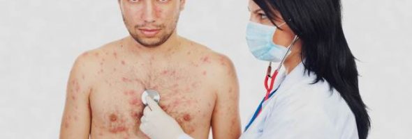 Ветрянка у взрослых