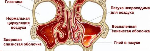 Что такое гайморит