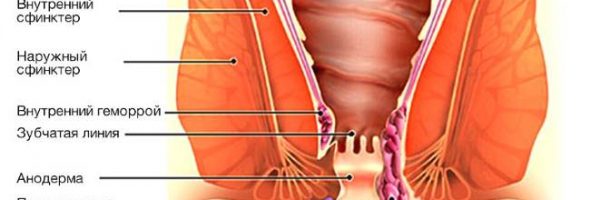 Что такое геморрой