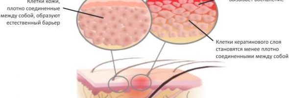 Атопический дерматит