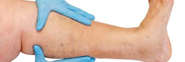 Варикозное расширение вен