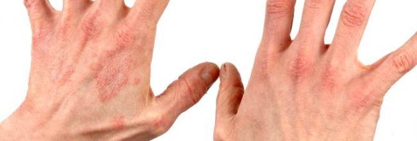 Дерматит на руках