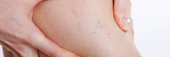 Начальная стадия варикоза