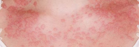 Аллергический дерматит