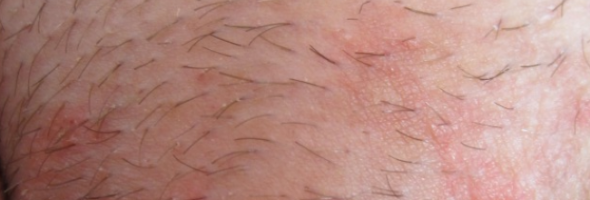 Аллергия на прокладки, синтетику и шерсть