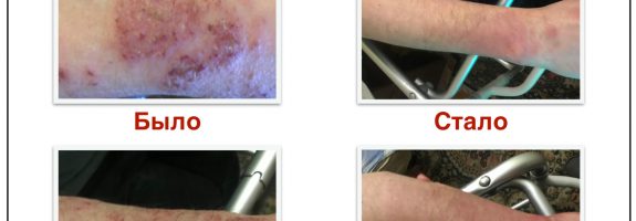 Как я победил псориаз. Личная история