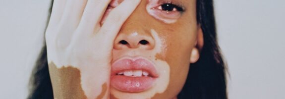 Как выглядит витилиго