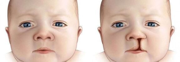 Как выглядит волчья пасть